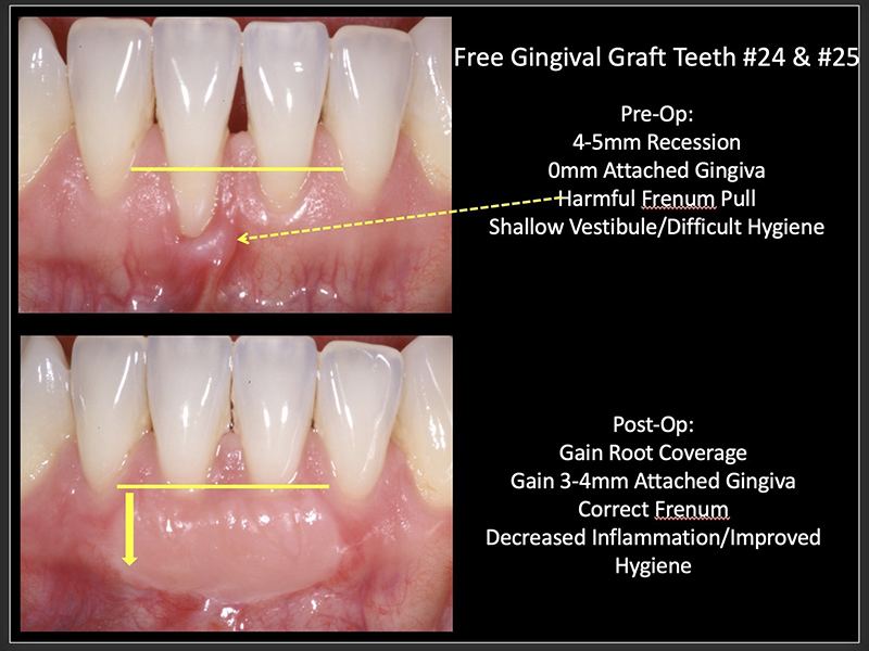 Gum contouring and gum grafts: before and after transformation