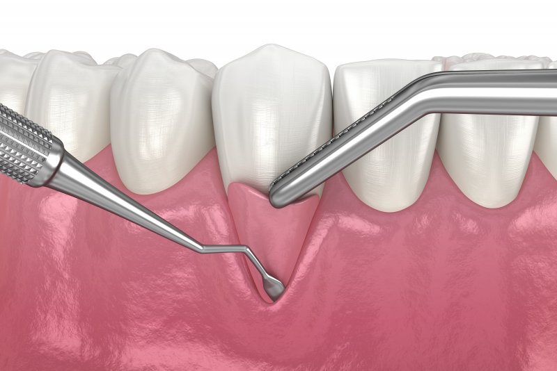 a digital image of a gum graft being perform on the lower arch of the mouth